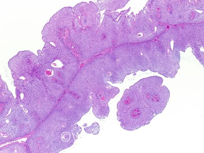 This is a hematoxylin and eosin stained histology slide of colonic mucosa examined under light microscopy in brightfield illumination. The specimen appears to show mucosal tissue from the large intestine with papillary or villiform epithelial protrusions, consistent with a mucosal polyp. The epithelium forms elongated, back-to-back glands lined by columnar cells with basophilic nuclei and moderate mucin-producing goblet cells; the lamina propria contains sparse inflammatory cells and a fibrous stroma in the core. There is no obvious invasion into submucosa. The architecture suggests benign polypoid proliferations such as a hyperplastic polyp or inflammatory polyp; however, small adenomatous changes cannot be excluded without higher magnification assessment for dysplasia, architectural complexity, and cytologic atypia. The slide emphasizes colonic mucosa without overt carcinoma. The differential includes hyperplastic polyp, inflammatory mucosal polyp, tubular adenoma, and serrated pathway lesions. Clinically, such images support histopathological diagnosis on colonoscopic biopsy and guide surveillance intervals. Potential use cases include educational training in gastrointestinal pathology, image-based teaching on mucosal polyps, and research into colorectal neoplasia progression. This image is suitable for algorithmic pattern recognition of mucosal polyp morphology and comparative histology studies. Metadata-ready keywords: histology, colon, mucosa, polyp, H&E, brightfield, microscopy, pathology training for clinical education and digital database.
