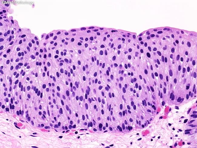 Histology slide of urothelium from urinary bladder mucosa, stained with Hematoxylin and Eosin, viewed under bright-field microscopy (paraffin-embedded, 4 µm sections; objective magnification approximately 40x). The urothelial lining is markedly thickened, comprising 12–15 cell layers. Basal cells appear prominent with preserved architecture, but there is loss of apical polarity accompanied by mild nuclear pleomorphism, nuclear enlargement, and hyperchromasia. Mitotic activity is not increased. No inflammatory infiltrate or infectious/reactive changes account for these cytologic abnormalities, and there is no evidence of stromal invasion or tumor formation in this field. Taken together, these features fall short of carcinoma in situ (CIS) and are most consistent with urothelial dysplasia (a premalignant lesion). Diagnostic significance includes recognition of precancerous change with potential progression to CIS or invasive urothelial carcinoma if unchecked. Differential considerations comprise CIS, high-grade urothelial neoplasm without invasion, and reactive/ regenerative atypia, though the latter lacks cytologic severity. Clinical correlation is essential, including cystoscopic assessment, urine cytology, and surveillance strategy; management may involve interval rebiopsy and risk-stratified follow-up. This image serves educational purposes for grading urothelial intraepithelial lesions and distinguishing dysplasia from CIS. Correlation with patient history and carcinogen exposure can further refine prognosis and monitoring. This image exemplifies urothelial dysplasia criteria.