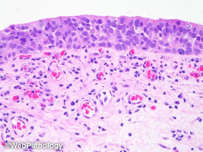 Image depicts light microscopic evaluation of oral mucosa with hematoxylin and eosin staining. Surface stratified squamous epithelium sits above a vascular lamina propria containing mixed inflammatory cells dominated by lymphocytes and plasma cells. The subepithelial tissue shows mild edema and capillary congestion without epithelial dysplasia, necrosis, or fungal granulomas. Overall pattern suggests nonspecific chronic mucosal inflammation or mild mucositis, potentially from irritation, infection, or autoimmune process. Clinically relevant for confirming inflammatory changes, guiding management of chronic mucositis, trauma related lesions, or infectious stomatitis, and differentiating from premalignant or malignant processes. Useful in educational, diagnostic, and research contexts to illustrate mucosal inflammatory histology and to support differential diagnosis in patients with oral mucosal lesions. Sampling technique, fixation, and stain quality influence interpretation and should be correlated with clinical findings and additional tests if indicated. Basement membrane zone appears intact with no subepithelial clefting or dyskeratosis evident at this magnification. This image serves as a reference for educational comparison to inflammatory conditions such as glossitis, stomatitis, lichen planus, candidiasis, or irritant contact lesions. In translational research, similar sections permit evaluation of infiltrate patterns, microvascular density, and matrix remodeling relevant to mucosal immunology and pathology.