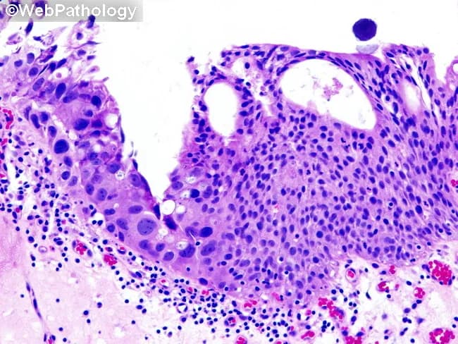 Imaging modality: Light microscopy of a hematoxylin and eosin stained urothelial biopsy from the urinary bladder. The section shows urothelium with carcinoma in situ (CIS) characterized by a flat, noninvasive lesion exhibiting extensive cytologic atypia throughout the thickness of the epithelium. The neoplastic cells display voluminous cytoplasm and markedly pleomorphic nuclei with prominent nuclear atypia and hyperchromasia, irregular contours, and frequent mitotic figures. This large cell, pleomorphic pattern is one of the most readily recognized forms of urothelial CIS. Adjacent right-hand mucosa demonstrates normal but hyperplastic urothelium, providing a contrast highlight of the malignant pattern. There is preservation of the basement membrane (as CIS is noninvasive) with crowding of atypical cells at the surface and disordered maturation. The stromal interface remains intact without invasion. Collectively, the image illustrates a high-grade urothelial carcinoma in situ occupying the epithelium, a critical diagnostic entity with significant risk of progression to invasive urothelial carcinoma if untreated. Clinically, CIS is associated with hematuria and is a marker of high-grade disease requiring immediate urological evaluation, cystoscopic surveillance, urine cytology, and potential intravesical therapy (BCG or chemotherapy). The pattern emphasizes the importance of recognizing large-cell pleomorphic CIS to prevent understaging and guide therapeutic decisions. This image serves educational and diagnostic planning use.