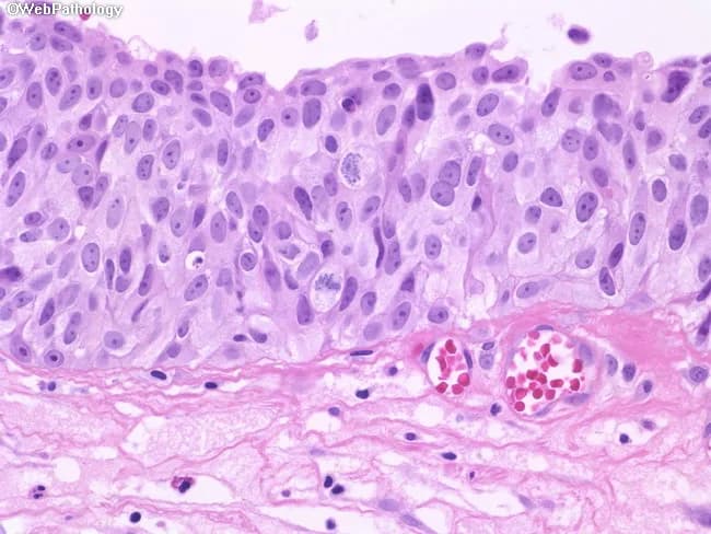 This histopathology image depicts a high-grade urothelial carcinoma in situ (CIS) of the urinary tract, captured by bright-field light microscopy on an H&E-stained section. The epithelium shows full-thickness neoplastic transformation of the urothelium with minimal pleomorphism but marked nuclear atypia. Neoplastic cells are relatively large, with abundant eosinophilic cytoplasm and enlarged, hyperchromatic nuclei; one or more prominent nucleoli are evident in several cells. Mitotic figures are readily visible, including atypical mitoses, reflecting high proliferative activity. A conspicuous finding is loss of normal basal polarity and disordered organization of cells relative to the basement membrane, consistent with CIS. The underlying lamina propria and stroma appear uninvaded at this level, though CIS is a known precursor to invasive urothelial carcinoma, underscoring oncologic significance. The sample demonstrates dense epithelial crowding with reduced cytoplasmic vacuolization and preserved cell borders in some areas, consistent with non-pleomorphic but malignant-appearing cells. Clinically, CIS signals a high-risk bladder cancer phenotype requiring definitive management and surveillance, including cystoscopy, urine cytology correlation, and possible intravesical therapy (BCG) or radical treatment if progression occurs. This image is valuable for educational teaching, pathology review, and research into urothelial neoplasia's in situ phase and its progression trajectory.