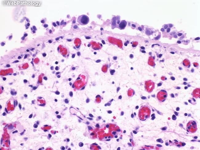 This bright-field light microscopy image depicts a bladder mucosal biopsy stained with Hematoxylin and Eosin (H&E) at high magnification (approximately 400x total). The surface urothelium is markedly reduced or denuded, revealing the underlying lamina propria with scattered cellular elements. Within the denuded field, clusters and individual cells exhibit high-grade cytologic features: enlarged, pleomorphic nuclei with hyperchromasia, irregular nuclear contours, and a high nuclear-to-cytoplasmic ratio. Occasional mitotic figures are present, supporting a neoplastic process. The background stroma contains mild to moderate inflammatory infiltrate, including lymphocytes and plasma cells, with scattered red blood cells in the interstitium. The combination of surface denudation and isolated malignant-appearing cells is characteristic of urothelial carcinoma in situ (CIS) with denudation, or denuding cystitis patterns described in bladder biopsies. In this context, urine cytology is frequently positive for malignant urothelial cells due to shedding from the abnormal surface. Accurate interpretation requires multiple histologic levels and correlation with clinical data, as reactive atypia can mimic CIS when surface epithelium is compromised. The image underscores the diagnostic challenge and the need for integration with adjunct tests (urine cytology, immunohistochemistry such as p53/Ki-67) and cystoscopic evaluation to confirm high-grade urothelial neoplasia and guide management (surveillance, intravesical therapy, or oncologic intervention).