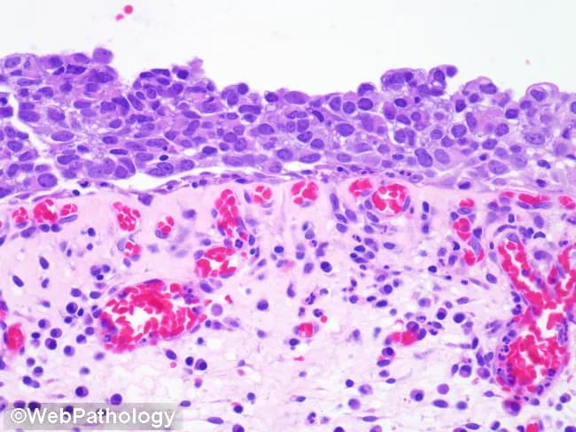 Imaging modality: Light microscopy of a hematoxylin and eosin stained bladder mucosa section. The lesion corresponds to urothelial carcinoma in situ (CIS) involving the urothelium of the bladder with preserved basement membrane but marked atypia. The urothelial layer shows widespread dysplastic, non-invasive malignant cells with marked nuclear pleomorphism and loss of polarity; nuclei are enlarged (approximately 4–6 times the size of surrounding small lymphocytes), hyperchromatic, with irregular nuclear contours. The architectural pattern is flat, without papillary fronds, consistent with CIS rather than invasive carcinoma. The lamina propria displays hypervascularized stroma with inflammatory infiltrate dominated by plasma cells and lymphocytes, indicating a reactive or inflammatory microenvironment accompanying CIS. Mitotic activity may be increased though not clearly described here. The differential includes dysplastic changes and benign reactive atypia; however, the combination of severe nuclear atypia, loss of polarity, full-thickness urothelial involvement, and dense inflammatory milieu supports a high-grade non-muscle-invasive urothelial carcinoma (CIS). Clinically this finding signals high risk of progression to muscle-invasive disease if untreated and warrants intravesical therapy and close surveillance. Correlation with cystoscopy, urine cytology, and patient risk factors (smoking, prior urothelial tumors) is essential. The image serves as a diagnostic teaching example for pathology education and oncology workflows.