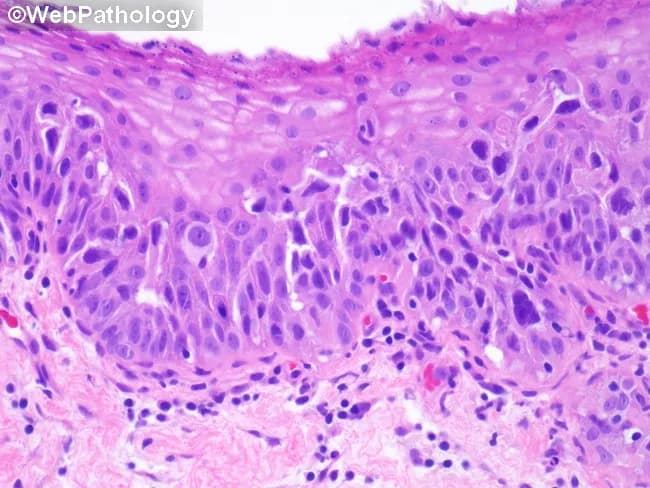 Histopathology examination of a urinary bladder urothelium specimen stained with Hematoxylin and Eosin reveals urothelial carcinoma in situ with pagetoid spread into areas of non-keratinizing squamous metaplasia. The epithelium shows full-thickness dysplasia characterized by marked cellular pleomorphism, enlarged hyperchromatic nuclei, prominent nucleoli, increased mitotic activity, and loss of polarity. Individual malignant cells are scattered singly and in small clusters within the urothelial layer and, notably, within metaplastic squamous foci, consistent with pagetoid spread. The squamous metaplasia itself demonstrates non-keratinizing features without evident keratin pearl formation. Basal layer continuity appears preserved, with no overt invasion into the underlying stroma evident in this field; however, CIS is a high-grade intraepithelial neoplasm with a risk of progression to infiltrative disease if not treated. The background shows mild chronic inflammatory infiltrate. Diagnosis: Urothelial carcinoma in situ with pagetoid spread into non-keratinizing squamous metaplasia of urothelium. Clinical relevance: high-grade intraepithelial lesion requiring staging and management decisions, including intravesical therapy or surgical consideration; differential includes high-grade urothelial carcinoma with squamous differentiation; correlation with cystoscopic findings and imaging advised; monitor for multifocal disease. Significance: recognizing pagetoid spread in CIS has prognostic implications, guiding surveillance intervals and intravesical therapy decisions. This image is valuable for pathology education and tumor biology studies on urothelial-squamous differentiation.