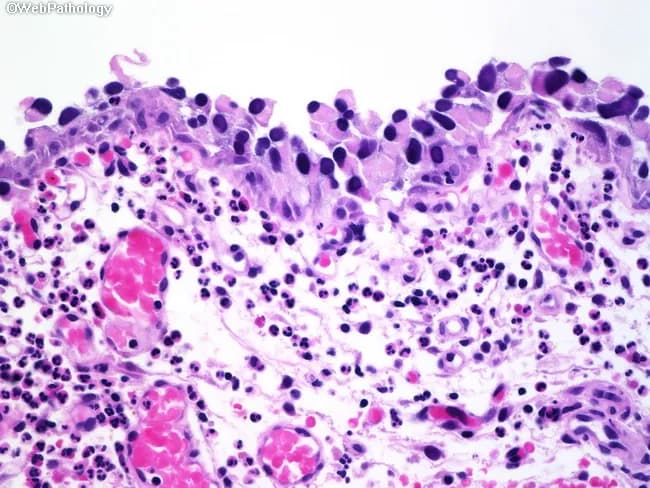 Light microscopy of an hematoxylin-and-eosin (H&E) stained bladder mucosa section showing urothelial carcinoma in situ (CIS). The specimen depicts urothelial epithelium with full-thickness high-grade atypia: markedly pleomorphic, hyperchromatic nuclei with prominent nucleoli and abundant eosinophilic cytoplasm, increased nuclear-to-cytoplasmic ratio, and conspicuous architectural disarray with loss of polarity. Basal and superficial layers demonstrate uniform dysplasia across the entire thickness, while the basement membrane remains intact, consistent with non-invasive disease. An acute inflammatory infiltrate is present in the underlying lamina propria, yet invasion is not evident. The histologic pattern is diagnostic of CIS and correlates with high-grade urothelial carcinoma in situ, a precursor to invasive urothelial carcinoma. Clinically, CIS carries a high risk of recurrence and progression and mandates intravesical therapy consideration (e.g., BCG) and close surveillance with cystoscopy and urine cytology. This image is valuable for diagnostic education, differential diagnosis with reactive urothelial changes, high-grade dysplasia, and invasive carcinoma, and for correlating histology with ancillary tests. The description supports precision in pathology reporting, guiding staging, treatment planning, and research on bladder cancer pathobiology. The image supports educational objectives in surgical pathology, cytology correlations, and multidisciplinary tumor boards; it also enhances database annotations for machine-assisted detection of non-invasive urothelial carcinoma and related premalignant lesions.