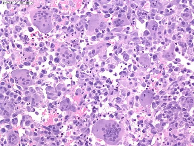 Modality: Light microscopy of a formalin-fixed bladder biopsy, single hematoxylin and eosin stained section. Comprehensive description: The tumor shows an admixture of osteoclast-type giant cells and mononuclear stromal cells with scant intervening necrosis and a fibrous to myxoid background. Osteoclast-like multinucleated giant cells are prominent, with abundant pale cytoplasm and variably sized nuclei, often showing conspicuous nucleoli. Interspersed mononuclear cells are pleomorphic and can exhibit atypia and mitotic activity. In some regions, conventional urothelial carcinoma components are present, reinforcing urothelial origin, while other areas may lack overt epithelial differentiation, recapitulating a giant cell tumor of bone-like morphology. The histology can mimic true giant cell tumors of bone, particularly when giant cells predominate and the stroma is relatively undifferentiated. This pattern represents an aggressive variant of urothelial carcinoma with poor outcome, higher propensity for invasion and metastasis, and increased risk of recurrence after resection. Immunophenotype typically supports urothelial lineage in carcinoma areas (e.g., cytokeratins, GATA3); osteoclast-like giant cells often express CD68. Clinically, this entity requires accurate diagnosis to guide management, given its dual components and potential therapeutic implications, including radical surgery, adjuvant therapy, and vigilant follow-up. This description emphasizes diagnostic nuances, therapeutic considerations, and prognostic implications for urothelial-origin neoplasms with giant cell components.