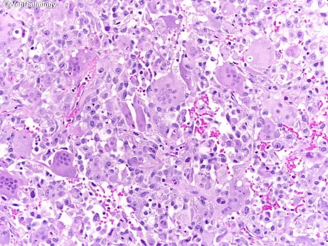 Imaging modality: Light microscopy of Hematoxylin and Eosin stained bladder tumor tissue. Primary subject: Osteoclast-type giant cell-rich urothelial carcinoma, a rare aggressive variant of urothelial carcinoma of the urinary bladder. Specimen: Bladder wall biopsy / surgical resection specimen. Perspective: Histopathology micrograph at high magnification showing cellular detail. In this image the osteoclast-type giant cells (multinucleated, large, eosinophilic cytoplasm) are interspersed with mononuclear tumor cells in a fibromuscular stromal background. Areas of conventional urothelial carcinoma are present in parts of the slide; the giant cells resemble those seen in giant cell tumors of bone. The tumor demonstrates marked cytologic atypia in the mononuclear component, frequent mitotic figures, and occasional necrosis; the stromal milieu may be inflammatory with capillary-rich vasculature. The combination signifies an aggressive biological behavior with poor prognosis. Clinically, this variant may be associated with early invasion and metastasis, and can mimic benign giant cell lesions histologically, necessitating careful differential diagnosis. Immunophenotyping typically shows urothelial markers in carcinomatous cells (e.g., GATA3, CK7/CK20) and histiocytic markers (CD68) in the giant cells. This image is relevant for educational diagnosis, differential diagnosis, and research on tumor heterogeneity within urothelial neoplasms and osteoclast-like giant cell-rich carcinomas. Potential use cases include pathology teaching, biopsy interpretation, and correlating histology with prognosis and therapy.