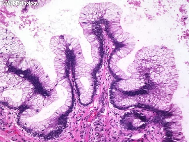 Histology image demonstrating mucosal villous projections lined by intestinal-type columnar epithelium with goblet cells. The architecture consists of elongated, finger‑like villi with uniform mucinous epithelium and goblet cell abundance. Nuclei are hyperchromatic and basally located with preserved polarity, consistent with low- to intermediate-grade dysplasia. Mitotic activity is not prominently increased, and the glandular crowding typical of high-grade dysplasia is absent. The superficial mucosa shows a columnar epithelial lining with a crypt-heavy layout and surface mucin production, surrounded by a fibrous lamina propria and mild accompanying inflammatory infiltrate. Overall, the mucosal lesion exhibits a villous adenomatous pattern rather than a serrated or hyperplastic configuration. Notably, goblet cells appear scattered within the epithelium, and the nuclei remain aligned basally without marked pseudostratification or mitotic atypia. This histomorphology supports a premalignant colorectal polyp with low-grade dysplasia and a risk of progression if left untreated. Clinically, such lesions are associated with colorectal polyps detected on colonoscopy and warrant endoscopic excision and histopathologic surveillance. Immunohistochemical staining for mismatch repair proteins or p53 is not necessary for routine diagnosis but may be employed in equivocal cases. The image underscores the importance of correlating endoscopic appearance with microscopic villous architecture to guide management and cancer prevention strategies today.