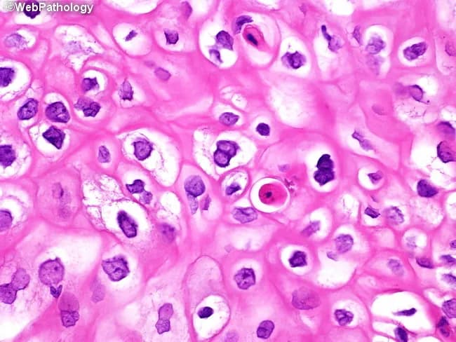 This histopathology micrograph depicts HPV-associated condyloma acuminatum involving urinary bladder mucosa, captured at high magnification with Hematoxylin and Eosin staining. The epithelium shows acanthotic, papillary squamous hyperplasia with koilocytotic cells featuring perinuclear halos, wrinkled raisinoid nuclei, and occasional binucleation. Dyskeratotic (dyskeratosis) cells are present in the upper spinous layer. Overall maturation is preserved, and cytologic atypia is limited, arguing against invasive squamous carcinoma. The lesion exhibits characteristic koilocytic change and surface/epithelial thickening consistent with a condylomatous pattern and verruciform architecture. In the bladder, such condylomas are recognized risk factors for subsequent development of squamous cell carcinoma or verrucous carcinoma; therefore, clinical management emphasizes surveillance and follow-up. The image supports an HPV-driven lesion and correlates with infectious etiologies rather than urothelial carcinoma. Differential diagnoses include squamous metaplasia, flat condylomatous dysplasia, and verrucous carcinoma when invasion is suspected; immunohistochemistry or HPV testing can aid confirmation. This depiction is valuable for educational purposes in pathology, urology, and gynecologic oncology, illustrating classic cytopathic changes (koilocytosis, nuclear wrinkling, binucleation, dyskeratosis) and the importance of correlating histology with clinical risk factors and follow-up imaging. Correlation with HPV typing and patient history may guide prevention and counseling.