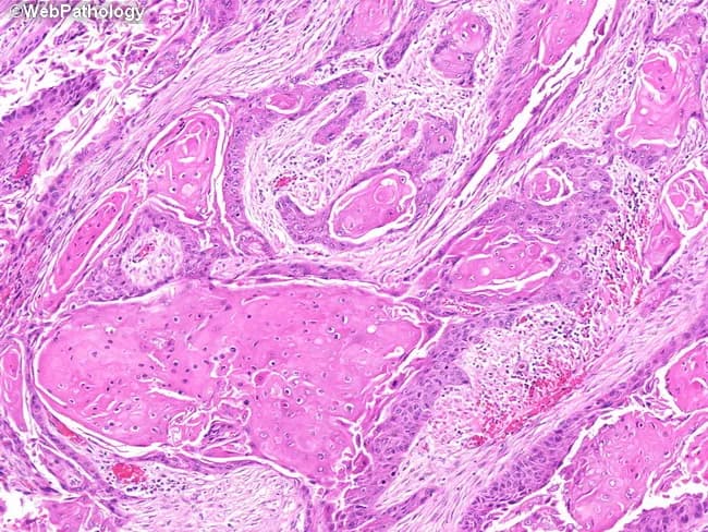 High-magnification histopathology image of oral mucosa showing keratinizing, well-differentiated squamous cell carcinoma with classic keratin pearl formation. The neoplasm displays nests and cords of malignant squamous cells invading the fibrous lamina propria, with abundant eosinophilic cytoplasm and intercellular bridges. Keratinization is evident both centrally within tumor nests and at the periphery, producing concentric keratin pearls of pale eosinophilic keratin. Tumor cells are relatively well differentiated, with recognizable squamous maturation and occasional mitotic figures. The adjacent mucosa demonstrates diverse epithelial alterations, including squamous metaplasia (keratinizing and nonkeratinizing variants), dysplasia, and areas consistent with squamous cell carcinoma in situ, reflecting field cancerization around the invasive focus. Inflammatory infiltrate and edema are present in the superficial lamina propria, while deeper stroma shows variable desmoplastic response. The surface epithelium may show thinning or ulceration over the lesion. No clear vascular invasion is evident at this magnification, though deeper planes could reveal invasion into connective tissue and perineural spread. This image provides valuable diagnostic features for distinguishing keratinizing SCC from nonkeratinizing variants and other mucosal neoplasms, and highlights the relevance of adjacent dysplasia/CIS as indicators of tumor field effect and oncologic margins. It serves as an educational reference for pathology, histology, and clinical tumor biology.