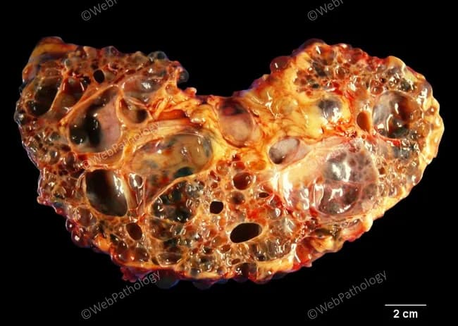This is a gross pathology photograph of an adult human kidney affected by autosomal dominant polycystic kidney disease (ADPKD). The organ is markedly enlarged (reniform in outline) yet preserves its overall bean‑shaped kidney morphology. On the cut surface, innumerable cysts of variable size disrupt the renal parenchyma, with some cysts less than 0.5 cm and others exceeding 6 cm in diameter. The cysts are fluid‑filled and appear transparent to reddish, cumulatively replacing much of the normal renal cortex and medulla, leaving only scant residual parenchyma between cavities. The external cortex is irregular, with a patchy, nodular feel, and the cortex–medulla junction is distorted by multilocular dilatations. This specimen derives from an autopsy of an adult male who had end‑stage renal disease from ADPKD and died of an unrelated cause; the kidneys reflect chronic, progressive cystic degeneration rather than an acute process. Clinically, ADPKD is a common hereditary cause of renal failure, characterized by bilateral renal enlargement, hypertension, and progressive decline in function; pathologically, multiple cysts originate from tubular epithelium and communicate loosely with collecting system. This image illustrates the phenotype, useful for education, differential diagnosis with other cystic nephropathies, and correlation with microscopic histology showing cystic dilation and fibrotic parenchyma.