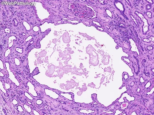 This renal histology image depicts cancellated cystic change characteristic of autosomal dominant polycystic kidney disease (ADPKD) examined with light microscopy. The tissue is stained with Hematoxylin and Eosin (H&E) and shows saccular dilation of tubular segments and Bowmanβs capsule, producing multiple cysts of variable size within the cortical parenchyma. The surrounding nephron units display alternating regions of normal-appearing tubules and dilated tubules that contribute to a heterogeneous,lobulated architecture. The cyst linings are typically cuboidal to flattened epithelium, often contiguous with shared basement membranes, and the cyst contents appear pale or eosinophilic depending on the presence of proteinaceous material. This histologic pattern reflects cystogenesis beginning at various nephron levels with progressive expansion of tubules and glomerular capsule remnants, a hallmark of ADPKD. The pericystic stroma may demonstrate mild interstitial changes but is not prominent in this field. Clinically, these findings correlate with bilateral renal cyst formation and progressive parenchymal disruption, contributing to hypertension and chronic kidney disease over time. In isolation, these features should be interpreted alongside clinical history, imaging studies, and genetic testing to confirm ADPKD (PKD1/PKD2 mutations) and to differentiate from acquired or pediatric cystic diseases. These histologic cues guide prognosis and inform targeted genetic testing strategies for patients.