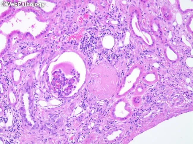 High-power brightfield histopathology of a renal cortical biopsy stained with Hematoxylin and Eosin (H&E) evaluated at approximately 400x magnification. The cortical nephron structures reveal changes typical of Autosomal Dominant Polycystic Kidney Disease (ADPKD) including a sclerotic, enlarged glomerulus with saccular expansion, indicating global or segmental sclerosis. Adjacent nephrons show distortion and dilatation of tubules with irregular luminal profiles and flattened, attenuated lining epithelium. The interstitial compartment displays mild inflammatory cells and periglomerular fibrotic changes, consistent with chronic injury and nephron loss. The overall architectural disruption reflects progressive cystic disease with reduced functional nephrons and compensatory remodeling, commonly seen in ADPKD. The image illustrates well the renal parenchymal consequences of polycystic diseaseβglomerulosclerosis, tubulomegaly, and tubulointerstitial fibrosisβcontributing to decreased glomerular filtration rate. Clinically, these histologic features correlate with imaging-detected bilateral renal cysts and polycystic kidney disease progression, abnormal renal function tests, hypertension, and potential renal failure in affected adults. This slide is valuable for education, differential diagnosis against other glomerulopathies and cystic kidney diseases, and research into cystogenesis, nephron loss, and remodeling in polycystic kidney disease. Keywords for search include: ADPKD histology, glomerulosclerosis, tubulomegaly, polycystic kidney disease pathology, kidney cortex, renal biopsy, brightfield, H&E, renal cysts. educational, clinical, research, nephrology, nephron remodeling.