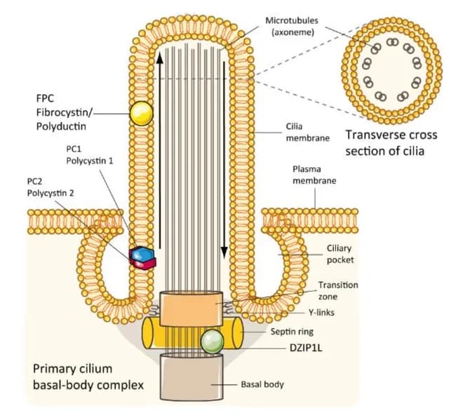This digital schematic illustration depicts the molecular pathophysiology of autosomal recessive polycystic kidney disease (ARPKD). The image emphasizes a renal tubular epithelial cell with its primary cilium emanating from the apical membrane of a collecting duct/loop of Henle segment. The left side labels the PKHD1-encoded fibrocystin (fibrocystin/polyductin) protein localized to the ciliary membrane and apical plasma membrane, illustrating its role in the ciliopathy pathway alongside polycystin-1 (PC1) and polycystin-2 (PC2). The diagram highlights the basal body–transition zone complex, with DZIP1L positioned at centrioles and the distal basal body, underscoring its necessity for trafficking gene products into the ciliary axoneme. A transverse section inset shows microtubule axonemes and the ciliary pocket, connecting to the primary cilium’s sensory function. Arrows denote intracellular trafficking and-lumen orientation. Dysfunctions in fibrocystin and DZIP1L disrupt ciliary signaling, promoting cystogenesis in ARPKD and reflecting a ciliopathy mechanism shared with other cystic diseases. The illustration also notes that fibrocystin is variably expressed in pancreatic and bile duct epithelium, consistent with multisystem involvement. This visualization serves educational purposes for genetics, nephrology, and cell biology, and supports research into targeted therapies addressing ciliary assembly and trafficking defects. Clinicians and students can correlate genotype–phenotype concepts with this concise framework for learning.