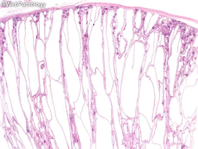 Imaging modality and technique: Light microscopy histology of renal tissue stained with Hematoxylin and Eosin (H&E). Specimen: Formalin-fixed paraffin-embedded kidney biopsy displaying medullary to cortico-medullary architecture. Anatomical region: Renal cortex and medulla with prominent dilated collecting ducts in the medulla. Visual features: Fusiform dilation of collecting tubules with long axis oriented perpendicular to the renal cortical surface, producing radiating arrays from medulla toward cortex. Cyst lining is a uniform cuboidal epithelium; cysts are irregularly distributed with thin fibrous septa containing normal glomeruli and tubules. Interstitium shows little or no fibrosis or inflammatory infiltrate in early disease; in longstanding disease, interstitial fibrosis and glomerulosclerosis may develop. Medullary cysts tend to be rounded; kidneys may show variable size and appearance in less severe cases, with less dramatic enlargement. In all ARPKD, additional liver pathology is present, including irregularly branching and anastomosing bile ductules and portal fibrosis, aiding distinction from infantile-adult polycystic kidney disease spectrum. Diagnostic relevance: The observed histology supports autosomal recessive polycystic kidney disease. Differential diagnoses include autosomal dominant polycystic kidney disease (ADPKD) and nephronophthisis; correlation with clinical history, age of onset, and hepatic involvement is essential. Potential clinical applications: confirm diagnosis in infants or children, guide genetic testing, inform prognosis, and stage hepatic involvement in congenital hepatic fibrosis.