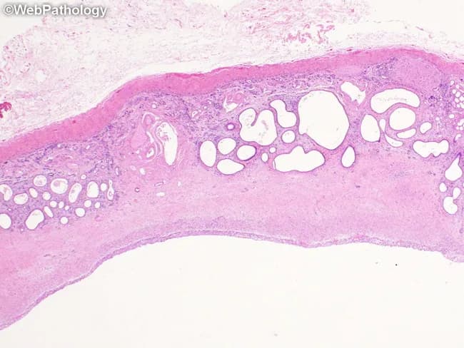 Histopathology slide of renal tissue from a case of multicystic dysplastic kidney (MKD). The section shows a large cyst with cyst wall lined by flattened to cuboidal epithelium and adjacent dysplastic parenchyma. Immature ducts and tubules are embedded in fibromuscular stroma, forming collarettes of primitive smooth muscle around these immature elements. Normal cortical architecture is disrupted with poor corticomedullary differentiation and sparse or absent mature glomeruli. The overall renal architecture is disorganized, reflecting dysplastic transformation rather than normal nephrogenesis. This pattern distinguishes MKD from pure hydronephrosis, which exhibits extreme thinning of the renal medulla and cortex without dysplastic features such as primitive ductal collars. Differential considerations include cystic Wilms tumor or mesoblastic nephroma, sporadic glomerulocystic kidney disease, tuberous sclerosis–associated renal lesions, and polycystic kidney disease. Clinically, these findings indicate a nonfunctional or poorly functioning renal unit and guide surgical planning, prognosis, and genetic counseling within the CAKUT spectrum, highlighting the importance of histology for accurate diagnosis and differential exclusion of neoplastic or other cystic kidney diseases.