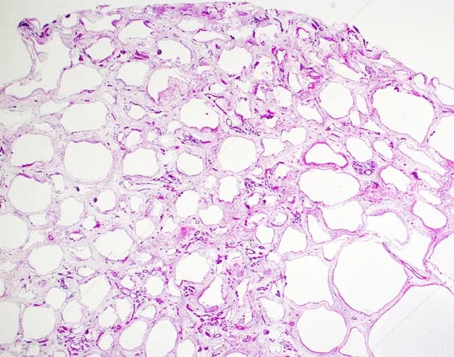 This histology image depicts white adipose tissue from subcutaneous hypodermis, prepared as a paraffin-embedded section and evaluated by bright-field light microscopy. The tissue demonstrates classic adipocyte lobules separated by delicate fibrovascular septa. Individual adipocytes appear as large, round to polygonal cells with abundant clear cytoplasm that contains a single, large lipid droplet, producing the characteristic empty-appearing space on hematoxylin–eosin staining. The nuclei are flattened and displaced to the periphery, creating a rim-like chromatin boundary. The extracellular matrix shows sparse collagenous septa and sparse vascular channels, with minimal inflammatory infiltrate. No cellular atypia or malignant features are evident. Overall, the architecture corresponds to normal white adipose tissue with relatively uniform adipocyte size, though physiologic variation in cell size can occur. This image is suitable as a morphologic reference for adipose tissue histology, comparisons in obesity-related studies, or teaching demonstrations of adipocyte biology and lipid storage. Clinically, white fat functions in energy storage, insulation, and endocrine signaling through adipokines; histology aids in evaluating conditions such as lipodystrophy, panniculitis, or lipomatosis when accompanied by clinical data. Keywords: adipocytes, unilocular, lipid droplet, peripherally displaced nucleus, H&E, hypodermis, subcutaneous fat. This description supports retrieval for educational, diagnostic, and research queries related to normal adipose histology and adipokine biology.