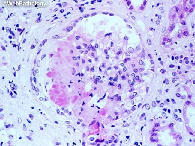 This is a light microscopy image of a formalin-fixed, paraffin-embedded tissue section stained with Hematoxylin and Eosin (H&E). The sample reveals a well-formed granulomatous lesion characterized by a surrounding cuff of lymphocytes and numerous epithelioid histiocytes with elongated, crescent-shaped nuclei. Within the granuloma, multinucleated giant cells (Langhans-type) are visible, and a central amorphous pink necrotic area (caseous necrosis) is evident. The tissue architecture demonstrates organized granulomatous inflammation with a necrotic core, consistent with infectious granulomas. The differential includes mycobacterial disease (tuberculosis) and certain fungal infections (histoplasmosis, coccioidomycosis), though non-necrotizing granulomas can occur in sarcoidosis. The staining highlights chromatin-rich nuclei and cytoplasmic eosinophilia; occasional fibroblasts and mild edema extend into the perigranulomatous region. Clinically, granulomatous tissue with caseation is highly suggestive of TB in the appropriate clinical context and warrants further diagnostic workup (acid-fast bacilli staining, fungal stains, culture, PCR). This image serves as teaching material for histopathology education, differential diagnosis of granulomatous inflammation, and correlation with radiologic and microbiologic findings in suspected infectious etiologies. Additional keywords for indexing: epithelioid macrophages, granuloma, necrosis, caseation, tuberculosis, mycobacteria, fungal infection, lymphohistiocytic rim, tissue biopsy, pathology slide, H&E, histology teaching. Clinical correlation with imaging and sputum analysis improves diagnostic yield.