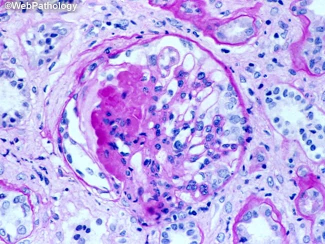 This is a histopathologic renal biopsy section demonstrating a glomerulus with marked tuft hypercellularity and eosinophilic, amorphous intraluminal material within capillary loops, compatible with fibrinoid necrosis or immune complex deposition. The surrounding cortex shows scattered inflammatory cells and mesangial proliferation. Hematoxylin and eosin staining highlights blue-nuclei inflammatory cells against pink extracellular matrix and pink eosinophilic material in the capillary walls, indicating endothelial injury and glomerular inflammation. The image captures features consistent with immune-mediated glomerulonephritis, with potential progression toward crescent formation in advanced disease. Diagnostic features include capillary wall damage, mesangial expansion, and periglomerular inflammatory infiltrates. Clinically, this pattern warrants differentiation among rapidly progressive GN, post-infectious immune complex GN, ANCA-associated vasculitis, anti-GBM disease, and lupus nephritis. Relevance to nephrology includes prognosis assessment, therapeutic decisions, and correlation with serology (complements, ANCA, anti-GBM, ANA). This image is valuable for education on glomerular pathology, differential diagnosis, and histologic correlates of renal inflammation. Correlative features may include basement membrane irregularity, endocapillary proliferation, and tubulointerstitial changes that influence prognosis and treatment planning. In teaching sets, this image demonstrates how immune injury manifests as capillary wall thickening, fibrin deposition, and cellular infiltrates within Bowman’s space, guiding students toward systematic differential reasoning and pattern recognition in nephopathology education.