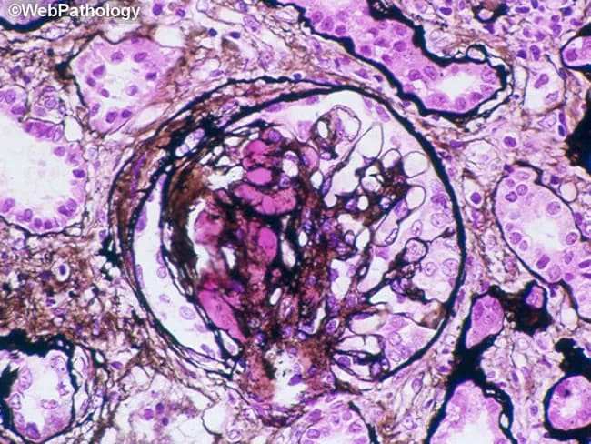 This renal histopathology image depicts a glomerulus in the renal cortex, examined under light microscopy after Hematoxylin and Eosin (H&E) staining. The glomerular tuft is round to ovoid, bounded by Bowman's capsule, and embedded in mild tubulointerstitial parenchyma. The capillary loops within the tuft show variable cellularity with modest mesangial proliferation and slight endothelial swelling. The basement membranes appear broadened in places, consistent with chronic or active injury. Some capillary walls harbor hyaline-like material that stains more eosinophilic, producing faint luminal narrowing. The surrounding tubular epithelium demonstrates typical cytoplasmic eosinophilia with preserved overall architecture but occasional luminal crowding. Overall, the image demonstrates a proliferative glomerular pattern with mild sclerosis potential, though global assessment is limited by single-field view. The observed morphology can be seen in glomerulonephritis and mesangial-dominant disorders, including early diabetic nephropathy, IgA nephropathy, or membranoproliferative patterns depending on additional staining and clinic. Clinically relevant, this pattern warrants correlation with proteinuria, serum creatinine, blood pressure, and serologies; immunofluorescence and electron microscopy would refine immune deposition, basement membrane thickening, and podocyte foot-process effacementβcritical for diagnosis and prognosis planning.