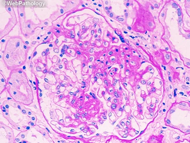 Imaging modality: light microscopy of renal tissue. A single glomerulus is shown in cross section from a renal cortical biopsy. The specimen is stained with Hematoxylin and Eosin (H&E) and viewed at high magnification. The glomerular tuft demonstrates increased cellularity within the capillary loops, consistent with endocapillary proliferation. Mesangial matrix appears expanded, and there are scattered infiltrating cells in the capillary lumens. Capillary lumina are variably narrowed, suggesting early glomerular inflammation. The basement membranes are not clearly visible as thickened in this field, and no overt segmental sclerosis or crescent formation is evident in this slice. The surrounding renal parenchyma shows mild tubulointerstitial involvement, including tubules with pale cytoplasm and interstitial edema, but the primary focus is the glomerulus. The staining highlights nuclei in blue and the extracellular matrix and cytoplasm in pink, typical of routine H&E preparation. This histopathology raises suspicion for a proliferative glomerulonephritis pattern, which can be seen in diseases such as postinfectious GN, IgA nephropathy, or lupus nephritis depending on ancillary tests. Clinically, findings may include hematuria, variable proteinuria, and potential decline in renal function; biopsy helps classify severity and guide therapy. Documentation of periglomerular inflammation and capillary loop involvement supports timely treatment decisions and assessment.