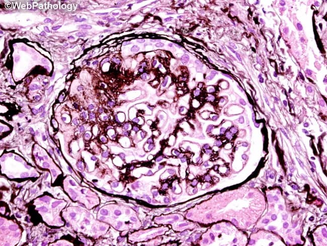 This image shows a renal glomerulus from a kidney cortex biopsy prepared for light microscopy and stained with Hematoxylin and Eosin (H&E), with alternate PAS-based cues. The circular renal corpuscle is bounded by Bowman's capsule, containing a tuft of capillary loops embedded in a dense mesangial matrix. Capillary lumina are variably patent, and the tuft exhibits focal thickening of the glomerular basement membranes suggested by intensified pink staining in the periphery. Mesangial expansion and subtle cellularity changes are evident, with nodular-like accumulations that give a lobulated contour to portions of the tuft. Surrounding tubulointerstitial tissue shows mild, non-destructive changes. Overall, the histologic pattern is compatible with a glomerular lesion characterized by mesangial expansion and potential nodular sclerosis, a feature classically described in nodular glomerulosclerosis and may reflect diabetic nephropathy, though clinical correlation is required. The image emphasizes glomerular architecture, basement membrane alteration, and mesangial pathology, all critical for differential diagnosis among glomerulonephritides. Clinically, such findings correlate with proteinuria, hypertension, and reduced renal function. This representation is valuable for educational purposes, enabling recognition of renal corpuscle anatomy, comparative evaluation of glomerular diseases, and integration of histology with nephrology practice and research.
