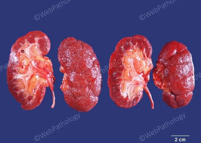 Autopsy gross photograph of the kidneys (human, bilateral) illustrating advanced diabetic nephropathy with nephrosclerosis. Modality: macroscopic pathology imaging; view: anterior/sagittal kidney sections arranged for direct comparison. Anatomical location: renal cortex with outer medulla; both kidneys show marked cortical thinning and a finely granular, leathery subcapsular surface consistent with chronic scarring. External contour is reduced in size, indicating symmetrically shrunken kidneys typical of end-stage nephropathy. Internal features reveal shallow cortical scars with sclerotic glomeruli, tubulointerstitial atrophy, and hyalinized arterioles with narrowed lumens (arteriolosclerosis), consistent with diabetic microangiopathy. Secondary findings include diffuse interstitial fibrosis and vascular remodeling. Pathophysiology: long-standing type 2 diabetes mellitus has driven glomerular and arteriolar hyalinosis, ischemic tubular loss, and progressive loss of cortical nephrons, culminating in renal insufficiency. Clinically significant: this image demonstrates the morphologic endpoint of diabetic nephropathy contributing to ESRD risk; supports diagnosis and educates on end-organ damage. Diagnostic considerations include hypertensive nephrosclerosis and age-related nephrosclerosis; differential guarded by clinical history. Clinical correlation: in life, patient had type 2 DM for 27 years; death due to myocardial infarction; underscores DM-related microvascular complications and their contribution to morbidity and mortality in diabetics. This image serves as a teaching aid for renal pathology and DM complications.
