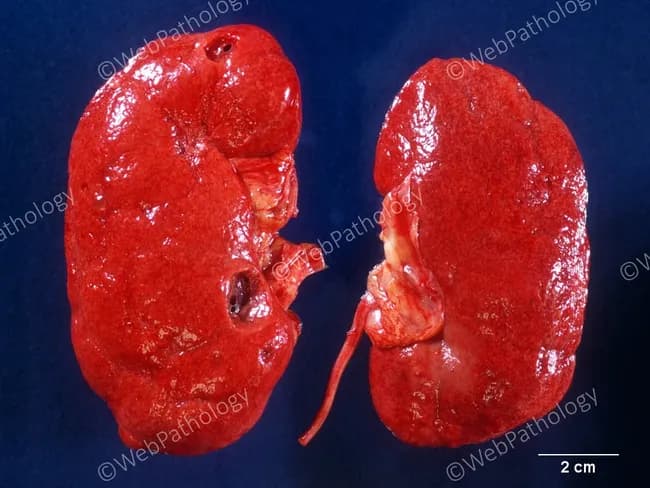Autopsy gross pathology photograph documenting bilateral renal nephrosclerosis in an elderly patient with long-standing diabetes mellitus and poor glycemic control. The kidneys are slightly reduced in size with a finely granular, subcapsular surface characteristic of nephrosclerosis. External cortex shows coarse granularity and reduced corticomedullary contrast, with a reddish-brown coloration suggestive of chronic ischemic injury. A few simple cortical cysts are present. The image provides macroscopic corroboration of diabetic nephropathy as a microvascular complication, where glomerulosclerosis and arteriolar hyalinosis produce progressive renal scarring, cortical atrophy, and diminished renal function. While histology is not shown, gross findings align with late-stage diabetic kidney disease and hypertension-related vascular changes. The scale bar indicates 2 cm for reference, enabling size assessment and morphologic comparison with other cases. Clinically, this morphology corresponds to microalbuminuria evolving to proteinuria, reduced GFR, and potential progression to end-stage renal disease if the disease persists. This specimen demonstrates typical end-organ damage in diabetes mellitus, with nephrosclerosis accompanied by incidental cortical cysts—a finding frequently observed in elderly individuals and in long-standing metabolic disease. Educationally, it serves as a reference image for medical students, pathologists, and researchers studying diabetic nephropathy and autopsy pathology.