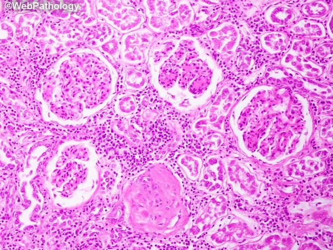 This is a light microscopy image of a renal biopsy from a patient with diabetes mellitus, stained with Hematoxylin and Eosin, viewed at high magnification (approximately 400x). The section comprises renal cortex with multiple glomeruli. Hallmarks of diabetic nephropathy are present: increased mesangial matrix with mesangial expansion surrounding capillary tufts, and one glomerulus showing global sclerosis consistent with advanced disease. The glomerular basement membranes appear thickened in the affected areas (as described in classic diabetic changes), though the image primarily highlights mesangial and sclerotic changes. Interstitium displays a chronic inflammatory infiltrate, indicating tubulointerstitial involvement associated with long-standing diabetes. Collectively these features reflect the triad of diabetic microvascular injury: mesangial expansion, GBM thickening, and arteriolar hyalinosis, contributing to progressive glomerulosclerosis and renal impairment. The observed pathology confirms diabetic glomerulopathy and provides diagnostic significance in evaluating proteinuria, decreased glomerular filtration, and CKD risk. In clinical practice, such histology supports staging of DN, guides management aimed at optimizing glycemic control, reducing hypertension, and preventing further renal decline. This image serves educational purposes for understanding pathophysiology of diabetic nephropathy, correlating morphological lesions with clinical severity, and illustrating typical glomerular sclerosis and interstitial inflammatory response in advanced disease.