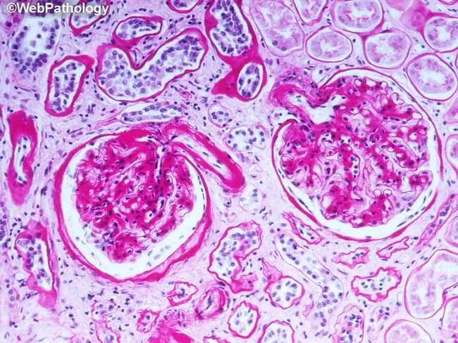 High-resolution light microscopic image of a Periodic acid–Schiff (PAS) stained renal biopsy section illustrating diabetic nephropathy microangiopathy. The specimen is renal cortex containing glomeruli with thickened glomerular basement membranes (GBM) and widened mesangial matrix. PAS positivity highlights hyaline material deposited in the glomerular capillary walls, Bowman’s capsule, and both afferent and efferent arterioles. The mesangial matrix shows expansion with increased PAS-stainable material; Bowman’s space remains patent but encroached by hyaline deposits. The overall pattern is consistent with early diabetic glomerulosclerosis, sometimes termed nodular sclerosis potential, though nodules are not clearly shown in this field. The image emphasizes microangiopathy changes associated with type 1 diabetes mellitus, which can appear within two years of onset and contribute to progressive proteinuria and renal impairment. The described glycosylated protein accumulation, decreased proteolysis, and trapped plasma proteins describe factors promoting PAS-positive deposition. Electron microscopy would better demonstrate GBM thickening, but the light micrograph suffices to identify diagnostic context. Clinically, these features underlie diabetic nephropathy and are used to stage renal involvement, guide glycemic and blood pressure control, and predict progression to overt nephropathy. In educational use, this image aids recognition of PAS-positive hyaline deposition in glomeruli, arterioles, and tubulointerstitial compartments for pathology students and clinicians.