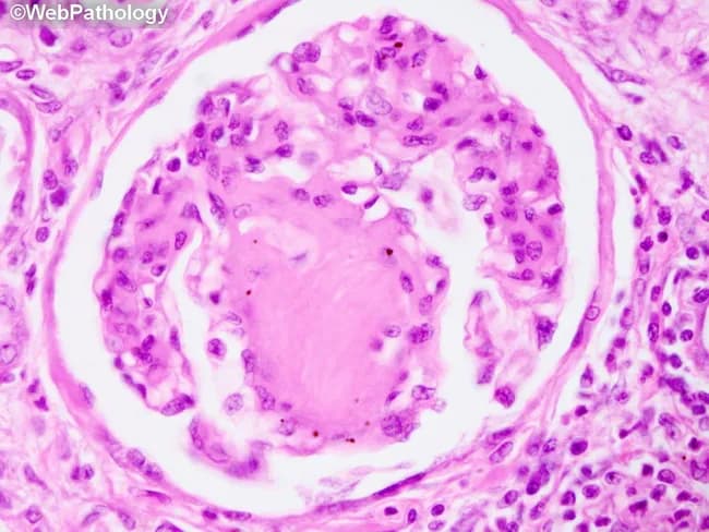 This renal histopathology image depicts nodular glomerulosclerosis, the hallmark Kimmelstiel-Wilson lesion of diabetic nephropathy. In this glomerulus, discrete round to oval nodules of eosinophilic mesangial matrix anchor the periphery of the tuft, creating a laminated, nodular architecture that expands the mesangial compartment and distorts capillary loops. The nodules are acellular or hypocellular and are readily identified with standard stains: Periodic acid–Schiff (PAS) staining yields strong positivity of the nodular deposits; silver staining (Jones silver) highlights mesangial matrix and basement membrane components; Congo red is negative, excluding amyloid; Masson trichrome stain characteristically colors the nodules blue, reflecting fibrous mesangial expansion. The surrounding capillary loops may remain patent or become markedly dilated, and disruption of the capillary-mesangial interface can predispose to capillary microaneurysm formation. This pattern results from increased synthesis and decreased degradation of mesangial matrix proteins with prolonged hyperglycemia (often >15 years) and is strongly associated with diabetic nephropathy progression. While KW nodules are characteristic, similar nodular deposits may be seen in light chain deposition disease, amyloidosis, hypertensive nephrosclerosis, or history of smoking without diabetes. Clinically, presence of KW nodular glomerulosclerosis correlates with proteinuria, reduced GFR, and prognosis of diabetic kidney disease, guiding therapeutic decisions including glycemic control, renin-angiotensin system blockade, and cardiovascular risk management.