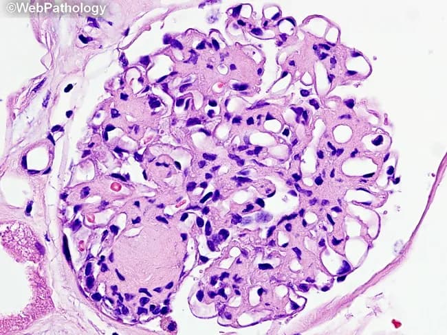 This is a renal biopsy histology slide examined under brightfield light microscopy. The primary subject is diabetic nephropathy with nodular glomerulosclerosis (Kimmelstiel-Wilson nodules) and diffuse mesangial sclerosis within the glomerular tuft of a renal cortex specimen. The glomerulus shows nodular mesangial expansion forming rounded, eosinophilic nodules that disrupt capillary loops, together with diffuse increased mesangial matrix. Capillary lumina are variably compressed, and arterioles frequently exhibit hyaline thickening consistent with diabetic microangiopathy. The cellular morphology is characterized by expanded mesangial cells with increased extracellular matrix and relatively sparse inflammatory infiltrate. The basement membrane appears thickened in cross-sectional elements. In this image, Masson’s trichrome is not visible; a subsequent stain would color collagen in blue, highlighting fibrotic remodeling. Clinically, these histologic features correlate with progressive proteinuria and reduced glomerular filtration rate in long-standing diabetes. Diagnostic significance rests on the combination of nodular sclerosis (Kimmelstiel-Wilson nodules) and diffuse mesangial sclerosis as hallmarks of diabetic nephropathy. Differential considerations include focal segmental glomerulosclerosis and hypertensive nephrosclerosis, but the nodular pattern is characteristic. This image is valuable for pathology education, nephrology training, and research into diabetic kidney disease progression and glycemic control effects. Representative for teaching clinics, this image supports correlating histology with clinical nephrology.