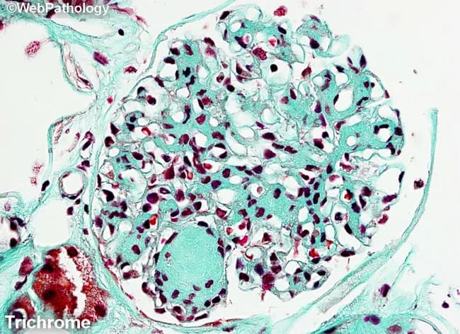 Masson's trichrome-stained renal cortex histology imaged at light microscopy reveals nodular glomerulosclerosis characteristic of diabetic nephropathy. The glomerulus shows circumscribed Kimmelstiel-Wilson nodules-eosinophilic mesangial nodules that expand the tuft and encroach on capillary loops. Diffuse mesangial sclerosis is evident as widespread mesangial matrix expansion, with increased basophilic mesangial tissue and accentuated blue-green collagen deposition in the extracellular matrix on Masson stain. The stain differentiates collagen (blue/green) from cytoplasm and nuclei (red/purple), highlighting the fibrotic nodules and mesangial expansion. Within the mesangium, there is progressive accumulation of matrix with variable cellularity; some capillary lumina appear narrowed due to nodular compression. The surrounding tubulointerstitial tissue may show mild chronic changes, consistent with chronic diabetic nephropathy. The overall pattern is typical of long-standing diabetes mellitus with nephropathy and correlates with progressive proteinuria, reduced glomerular filtration rate, and eventual renal insufficiency. Clinically, this finding supports diagnosis of diabetic kidney disease (diabetic nephropathy) and is essential for grading disease stage and guiding management. Differential diagnoses include nodular glomerulosclerosis due to amyloidosis or hypertensive nephrosclerosis, but the classic KW nodules and mesangial expansion favor diabetes. This image is valuable for medical education, pathology training, and research into diabetic renal pathology.
