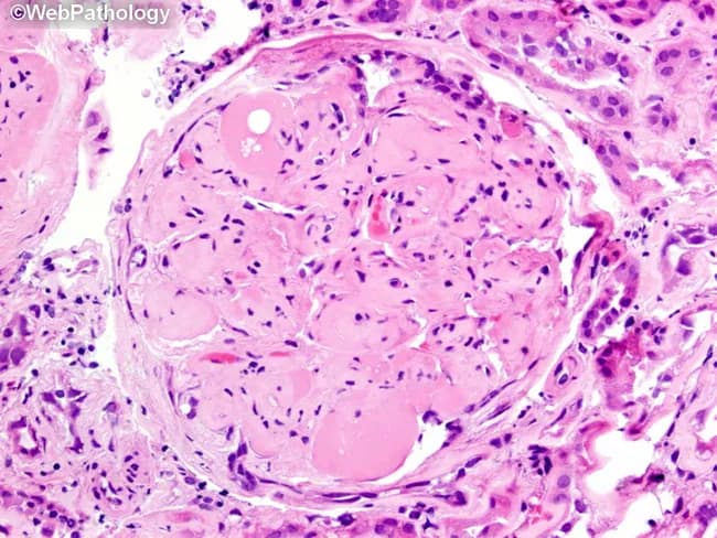 Imaging modality: brightfield histopathology. This slide shows a renal glomerulus from a biopsy specimen of diabetic nephropathy. The mesangial matrix is markedly expanded, producing round to nodular consolidations within the tuft. Several Kimmelstiel‑Wilson nodules are evident as acellular, hyaline nodules that distend the mesangial stalks and encroach on capillary loops. The glomerular basement membranes appear thickened on corresponding PAS‑positive and silver‑stained sections (referenced in adjacent images), consistent with nodular diabetic glomerulosclerosis. The surrounding cortex exhibits mild chronic interstitial changes and arteriolar hyalinosis in keeping with chronic diabetic kidney disease. The glomerulus displays relatively extensive mesangial deposition with focally patent capillary lumina, creating a characteristic nodular pattern. Overall, the morphology is diagnostic for diabetic microangiopathy with progressive nodular sclerosis. Clinically, these findings correlate with long‑standing hyperglycemia, proteinuria, and reduced GFR. Pathological significance: KW nodules indicate advanced disease and higher risk of progression to end‑stage renal disease. Differential considerations include non‑diabetic nodular glomerulosclerosis and other glomerulopathies, but the classic KW nodules and mesangial expansion strongly support diabetic nephropathy. This image is valuable for education, pathology review, and correlating histology with clinical diabetes management. It highlights key features for learners: mesangial expansion, KW nodules, PAS positivity, and altered capillary luminal flow in practice.