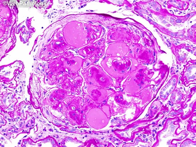 This is a renal biopsy histology slide prepared with Periodic acid–Schiff (PAS) stain and imaged by light microscopy at high magnification. The primary structure is a renal glomerulus within the renal cortex. The specimen shows nodular glomerulosclerosis characteristic of advanced diabetic nephropathy. Mesangial matrix is markedly expanded, producing discrete, rounded nodules (Kimmelstiel-Wilson nodules) that project into the glomerular tuft. The nodules are PAS-positive and appear eosinophilic, encroaching on capillary loops and occasionally compressing the capillary lumina. Surrounding glomerular capillary walls may display mild thickening and subtle fragmentation of the basement membrane. The peripheral cortex and interstitium show variable inflammatory cells and sclerosis consistent with chronic injury. Overall, the architecture is distorted by nodular sclerosis with a waxy, hyaline appearance within mesangial areas. The pattern is highly suggestive of diabetic nephropathy with nodular (Kimmelstiel-Wilson) glomerulosclerosis; differential includes focal segmental glomerulosclerosis, amyloidosis, and hypertensive nephrosclerosis. Clinically, such findings correlate with long-standing hyperglycemia, progressive proteinuria, and declining glomerular filtration rate. Immunofluorescence would typically be non-specific for this lesion, while electron microscopy would show thickened basement membranes and mesangial expansion. This image is valuable for educational illustration of diabetic renal pathology and differential diagnosis in nephrology.
