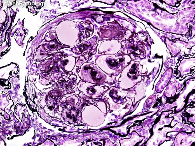 This histopathology image shows a renal glomerulus from a kidney biopsy, examined with bright-field light microscopy after Jones’ methenamine silver staining. The primary subject is nodular glomerulosclerosis associated with diabetic nephropathy. The mesangial matrix is markedly expanded, producing discrete Kimmelstiel–Wilson nodules within the glomerular tuft. These eosinophilic, rounded nodules compress adjacent capillary loops and disrupt normal capillary architecture. The glomerular basement membranes appear thickened, a feature accentuated by the silver stain as dark outlines surrounding the sclerotic nodules. The surrounding mesangial matrix shows increased density, while capillary lumina are variably narrowed. Bowman’s space is variably preserved, and there may be mild hyalinosis of arterioles consistent with diabetic microangiopathy. Overall, the image displays the classic triad of diabetic nephropathy: mesangial expansion, nodular glomerulosclerosis (KW lesions), and GBM thickening. Diagnostic significance is high for long-standing diabetes with renal involvement and proteinuria; the findings contribute to staging and prognosis. Differential considerations include nodular FSGS and nodular amyloidosis, but the appearance of discrete KW nodules is characteristic. Clinically, these histologic changes correlate with reduced GFR and progression to chronic kidney disease; management emphasizes glycemic control and anti-hypertensive therapy. This image is suitable for teaching, case reviews, and pathology QA.