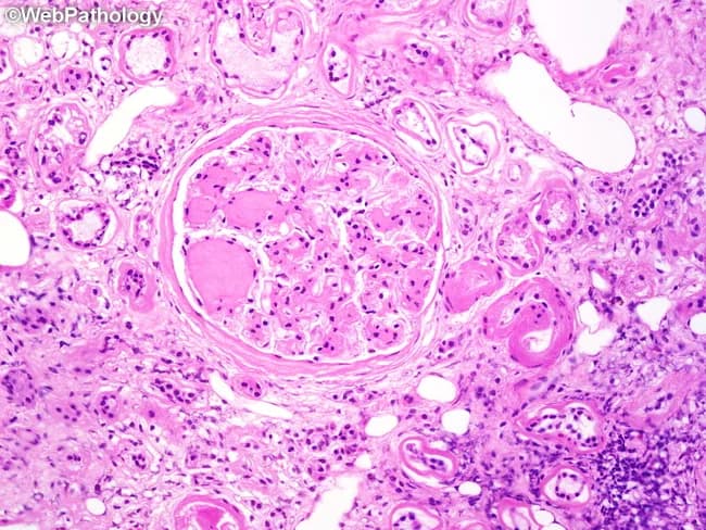 Imaging modality: Light microscopy of a renal biopsy specimen stained with Hematoxylin and Eosin (H&E). The focal region of interest is the glomerulus from the renal cortex, with mid-power to high-power view illustrating nodular mesangial sclerosis typical of diabetic nephropathy. Central to the image are Kimmelstiel–Wilson nodules: spherical, acellular to pale pink nodules within the mesangial matrix that disrupt normal glomerular architecture and compress capillary tufts. Surrounding glomerular capillary loops show mesangial expansion; there are also arterioles adjacent to the glomerulus with arteriolar hyalinosis (hyaline thickening of small vessels) on the external side; this hyaline arteriolosclerosis reflects chronic ischemic injury from hyperglycemia. The periglomerular interstitium exhibits chronic inflammatory infiltrate and mild interstitial fibrosis, consistent with long-standing diabetic kidney disease. The specimen demonstrates features of nodular diabetic glomerulosclerosis with associated vascular and interstitial changes, which collectively contribute to progressive proteinuria and renal insufficiency. Clinically, these histopathologic findings corroborate diabetic nephropathy in patients with long-standing diabetes mellitus, correlating with stage of kidney involvement, guiding management such as optimized glycemic control, renin-angiotensin system blockade, and nephroprotective strategies. Differential considerations include nodular glomerulosclerosis due to other etiologies (e.g., light chain deposition disease) but KW nodules are classic for diabetic nephropathy. These findings guide prognosis.