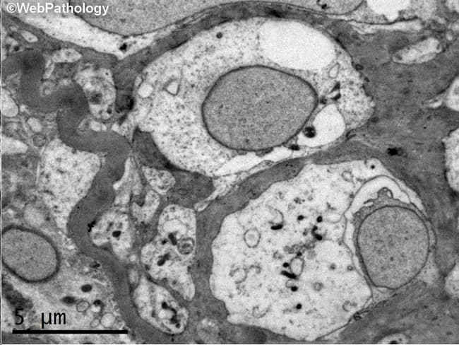 This Transmission Electron Microscopy (TEM) image of a renal glomerulus demonstrates diffuse thickening of the glomerular basement membrane (GBM), an ultrastructural hallmark of diabetic nephropathy. The sample is a renal biopsy from a patient with type 1 diabetes mellitus, illustrating early intraglomerular microangiopathy within approximately two years of disease onset. In TEM, the GBM appears markedly thickened, with increased electron density and reduced capillary luminal space; podocyte foot processes may show effacement, though not clearly identifiable in this static field. The specimen is oriented in the glomerular capillary loops within the renal cortex; scale bar indicates 5 μm, reflecting ultrastructural resolution. Clinically, GBM thickening correlates with progression to overt proteinuria and chronic kidney disease; however, nodular sclerosis (Kimmelstiel-Wilson lesions) and overt glomerulosclerosis develop later. This image underscores the value of electron microscopy for early detection of diabetic microangiopathy when light microscopy may be less sensitive. Diagnostic significance lies in confirming diabetic nephropathy in the appropriate clinical context, differentiating from other glomerulopathies where GBM thickening may occur, such as membranous nephropathy or hypertensive nephrosclerosis. Potential uses include educational illustration of early diabetic kidney disease, research into ultrastructural changes in diabetes, and aiding pathology concordance with clinical diabetes management and nephrology planning.