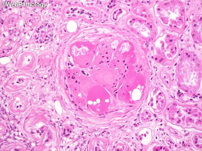 This is a renal biopsy histology image captured under bright-field light microscopy after Hematoxylin and Eosin staining. The focal structure is a glomerulus in the renal cortex showing near-complete global glomerulosclerosis with a markedly hyalinized tuft. Several hyaline caps outline the sclerotic core, appearing as pink, glassy deposits along capillary loops. Within these hyaline rims, lipid droplets and lipid-laden macrophages are evident, reflecting lipid accumulation associated with chronic diabetic microangiopathy. The surrounding tubulointerstitium displays mild interstitial fibrosis and preserved tubules in the periglomerular region. Collectively, the pattern is typical of advanced diabetic nephropathy with extensive glomerulosclerosis and hyaline arteriolosclerosis. The image highlights pathognomonic features such as noncellular sclerosis and lipid-laden inflammatory cells, which have prognostic implications for progressive renal insufficiency. Clinically, these findings correlate with long-standing diabetes mellitus, hypertension, proteinuria, and reduced GFR, indicating high risk for progression to end-stage kidney disease if glycemic control is poor. This specimen serves educational purposes in renal pathology, nephrology, and medical training to illustrate diabetic glomerulosclerosis, hyaline change, and lipid-related macrophage infiltration; it supports differential diagnosis with hypertensive nephrosclerosis and focal segmental glomerulosclerosis.