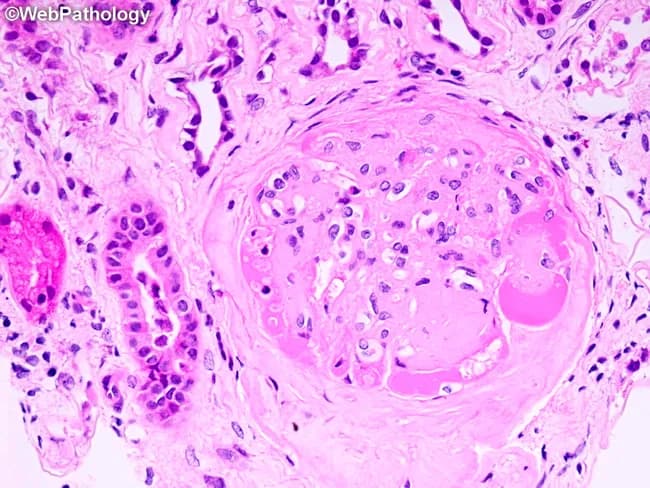 Comprehensive Description: The image depicts a renal glomerulus studied by light microscopy on a hematoxylin and eosin stained section. The cortical glomerulus shows marked mesangial expansion with sclerosis, a hallmark of diabetic nephropathy. A classical Kimmelstiel-Wilson nodular lesion is evident at approximately the 5–6 o’clock position within the tuft, appearing as a rounded, PAS-positive eosinophilic nodule composed of matrix and mesangial material encroaching on capillary loops. Surrounding capillary lumina are variably narrowed by eosinophilic hyaline caps, consistent with nodular glomerulosclerosis and hyaline arteriolosclerosis of diabetic microangiopathy. The glomerular basement membranes are thickened, and there is proliferation of mesangial matrix with increased cellularity in some areas. The periglomerular stroma shows interstitial inflammation and edema. Overall, these features reveal chronic hyperglycemia-induced glomerular damage with progressive loss of filtration surface area, correlating with proteinuria and progressive chronic kidney disease risk. The image demonstrates pathognomonic nodular sclerosis in long-standing diabetes mellitus, requiring correlation with clinical history, duration of diabetes, blood pressure control, and renal function tests. This slide exemplifies diabetic nodular glomerulosclerosis (KW disease) and is a classic teaching example for renal pathology and medical education in nephrology. Correlation with clinical data strengthens educational utility for nephropathology training.