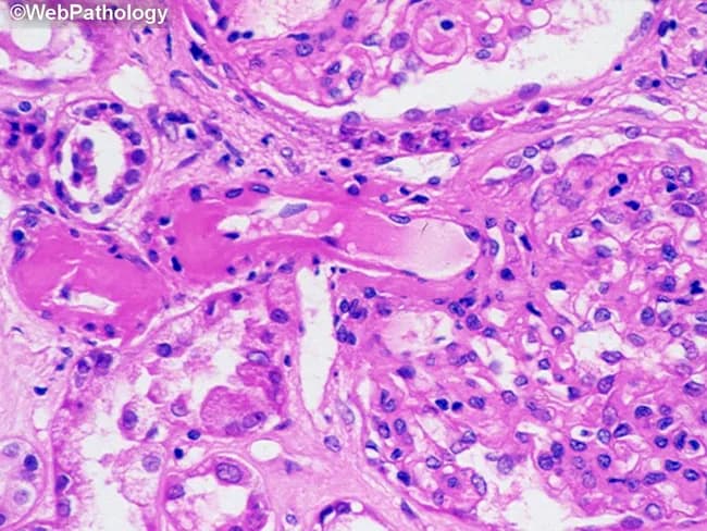 Light microscopic histology image of renal parenchyma showing hyaline arteriolosclerosis in both afferent and efferent arterioles, a vascular lesion characteristic of diabetic nephropathy. The tissue is a kidney biopsy specimen stained with Hematoxylin and Eosin (H&E). The arteriolar walls appear thickened with homogeneous eosinophilic hyaline material that narrows lumens, consistent with progressive hyalinosis. The glomeruli may display mesangial expansion and subtle sclerosis in larger examples, while surrounding tubules and interstitium show variable chronic change. This vascular involvement reduces renal perfusion, contributing to ischemic injury and progressive proteinuria typical of diabetes mellitus–related kidney disease. The image highlights a relatively rare finding of arteriolar hyalinosis in both afferent and efferent arterioles, which can help distinguish diabetic nephropathy from non-diabetic hypertensive arteriolosclerosis where efferent arteriolar involvement is less common. Accurate recognition of these hyaline deposits is essential for differential diagnosis, prognosis, and guiding therapy aimed at glycemic control and blood pressure management. Clinically, the presence of arteriolar hyalinosis correlates with decreased renal filtration rate and can precede overt nephrotic syndrome. In educational and research contexts, this image is valuable for teaching diabetic microvascular complications, renal histopathology, and correlating histology with clinical labs such as microalbuminuria and serum creatinine elevations.