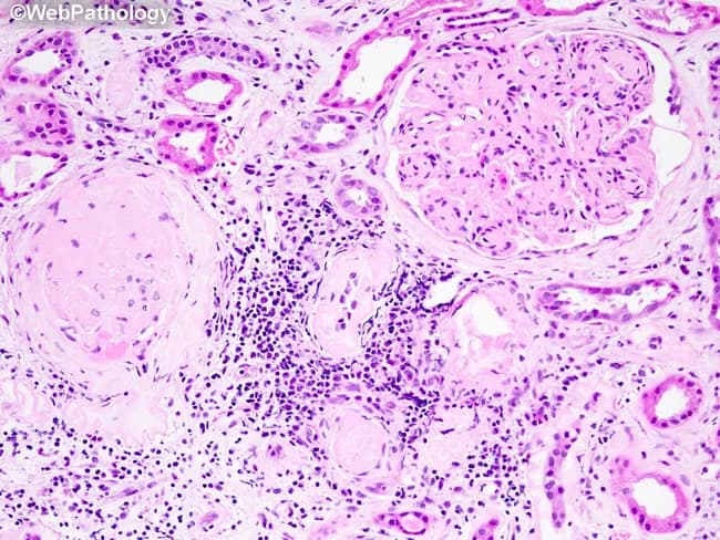 This histopathology image displays a renal cortex biopsy stained with Hematoxylin and Eosin and observed under bright-field light microscopy. The core features of diabetic nephropathy are evident: mesangial widening with expansion of the mesangial matrix and a globally sclerotic glomerulus, indicative of advanced glomerulosclerosis. Tubular basement membranes appear thickened, reflecting chronic microangiopathy and diabetic tubulopathy. The interstitium shows inflammatory infiltrates consistent with chronic interstitial inflammation and potential tubular injury. The overall renal architecture is altered by progressive scarring while some glomeruli retain reference morphology. These changes typify diabetic kidney disease in long-standing diabetes, often accompanying proteinuria, hypertension, and reduced glomerular filtration rate. The lack of nodular Kimmelstiel-Wilson lesions may reflect a particular stage. Notable differential considerations include hypertensive nephrosclerosis or chronic glomerulonephritis; however, the combination of mesangial matrix expansion, global sclerosis, and TBM thickening strongly supports diabetic nephropathy. Clinically, these histologic features correlate with reduced renal function and microalbuminuria, guiding therapeutic decisions such as optimization of glycemic control and renin-angiotensin-aldosterone system blockade. This image is valuable for educational, diagnostic, and research contexts, enabling recognition of advanced DN pathology and correlation with clinical diabetes duration and nephropathy progression.