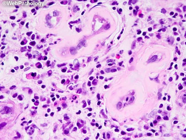 This histopathology image shows a renal biopsy section examined by light microscopy after Hematoxylin and Eosin staining, captured at high power to emphasize tubulointerstitial pathology associated with diabetic nephropathy. The cortical interstitium contains chronic inflammatory infiltrates composed predominantly of T lymphocytes and macrophages within areas of established interstitial fibrosis, reflecting long-standing injury. Eosinophil aggregates are conspicuous in the interstitium and can resemble tubulitis or tubulointerstitial nephritis. The tubular compartment demonstrates varying degrees of tubular atrophy and epithelial cell changes, with relative sparing of some glomeruli; when present, glomerular lesions of diabetic nephropathy such as mesangial expansion or nodular sclerosis may accompany the interstitial process but are not the defining feature in this field. Occasional neutrophils and, in places, neutrophil casts indicate a superimposed acute bacterial process and raise suspicion for acute pyelonephritis, a complication more common and often more severe in diabetes. Papillary necrosis is a theoretical progression in diabetics with infection and ischemic injury. Clinically, these findings correlate with chronic kidney disease from diabetes and heightened infection risk, underscoring the need for glycemic control, infection screening, and careful nephrotoxic exposure assessment. Differential diagnoses include chronic tubulointerstitial nephritis and drug-induced interstitial nephritis; clinicopathologic correlation is essential for definitive attribution.