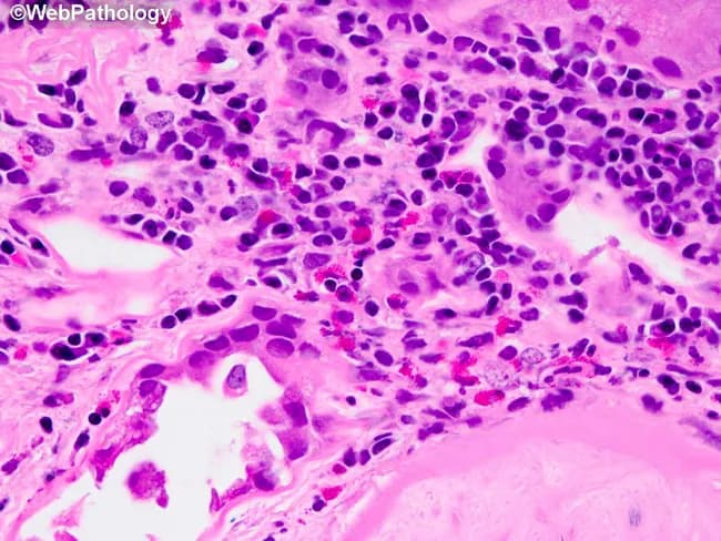 Renal biopsy tissue examined by light microscopy after Hematoxylin and Eosin staining reveals tubulointerstitial changes characteristic of diabetic nephropathy with superimposed inflammatory activity. The interstitial compartment shows a chronic inflammatory infiltrate dominated by T lymphocytes and macrophages, with scattered eosinophils forming small aggregates within fibrosed stroma. Tubules within the affected area display varying degrees of injury, including tubular atrophy and mild tubulitis, consistent with chronic kidney disease in diabetes. The surrounding interstitium appears fibrotic, with collagen deposition and loss of peritubular capillaries, creating a scar-like background that can obscure normal architecture. Notably, the image emphasizes the potential for neutrophilic infiltration and neutrophil casts, findings that may signal superimposed acute pyelonephritis, a known complication in diabetic patients. When infection is present, papillary necrosis and further destruction of renal parenchyma may ensue. Overall, the depicted histology aligns with a diabetic nephropathy spectrum where chronic inflammation coexists with fibrosis and occasional acute inflammatory components, raising clinical concerns for infection, rapid decline in renal function, and the need for targeted antimicrobial therapy and glycemic optimization. Clinically relevant differential considerations include tubulointerstitial nephritis of non-diabetic etiology and superimposed bacterial nephritis; correlation with serum creatinine and imaging improves diagnostic precision.