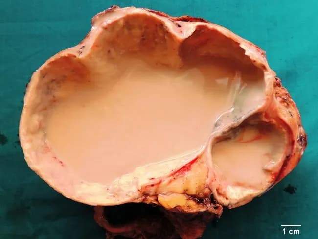 This gross pathology photograph depicts a right nephrectomy specimen with advanced hydronephrosis and pyonephrosis. The kidney is markedly enlarged and cut open to reveal an extensively dilated pelvicalyceal system filled with thick purulent material, while the renal cortex is exceedingly thinned, producing a paper-thin rim of parenchyma. The interior contains approximately three liters of creamy yellow pus and necrotic debris, reflecting suppurative destruction of the parenchyma and end-stage renal disease secondary to chronic obstructive uropathy. Histologic correlate shows xanthogranulomatous inflammation with foamy macrophages amid necrosis and granulomatous reaction, consistent with long-standing infection and obstruction. Urinary tract calculi are present in the ureter, and hydroureter accompanies the severely dilated collecting system. The gross features exemplify the classic evolution from obstructive uropathy to infected hydronephrosis, ultimately necessitating nephrectomy when function is lost. Clinically, the patient presented with high fever, flank pain, dysuria, and turbid urine with pyuria; urine cultures grew Escherichia coli. This image is valuable for teaching radiology-pathology correlation, surgical pathology training, and urologic management, illustrating the diagnostic significance of hydronephrosis complicated by infection and the rationale for drainage, antimicrobial therapy, and nephrectomy in non-functioning kidneys. It supports differential considerations including xanthogranulomatous pyelonephritis and chronic obstructive nephropathy.