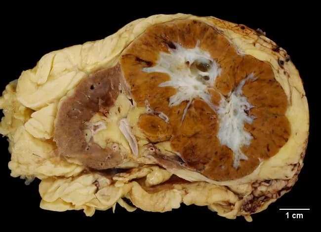 Gross macroscopic image of a kidney nephrectomy specimen displaying a solitary renal mass. The cut surface is mahogany brown to yellow-brown, with a well-circumscribed, but not clearly encapsulated, tumor replacing a portion of the renal cortex. A distinct white, stellate central scar is visible in the majority of the sectioned tumor areas, particularly in larger tumors, and commonly corresponds to fibrous stroma and degenerative changes. The surrounding renal parenchyma appears otherwise unremarkable, with a sharp pseudocapsule and clear delineation between lesion and normal cortex. The lesion demonstrates a heterogeneous color pattern on gross inspection, lacking overt hemorrhage or necrosis. The specimen is imaged in a gross pathology setting, with a ruler indicating scale (approximately 1 cm divisions) to convey tumor dimensions. The overall morphology—well-circumscribed borders, discrete cortical involvement, mahogany coloration, and central scar—aligns with classic features described for renal oncocytoma, a benign epithelial neoplasm arising from collecting ducts (intercalated cells) of the kidney. Clinically, renal oncocytoma accounts for a minority of renal tumors and is frequently discovered incidentally on imaging studies performed for unrelated indications. Although benign, differentiation from renal cell carcinoma remains essential; histology and immunohistochemistry are commonly employed to confirm the diagnosis. This image is intended for education.