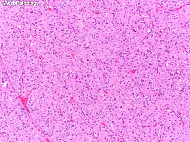 This histopathology photomicrograph displays a renal tumor tissue section stained with Hematoxylin and Eosin (H&E) at high magnification. Tumor cells are arranged in densely packed nests and interlacing trabeculae with a predominantly solid growth pattern. Cells have abundant eosinophilic cytoplasm, distinct cell borders, and minimal cytoplasmic vacuolization. Nuclei vary slightly in size and contour, often showing irregular outlines, occasional binucleation, and conspicuously irregular chromatin. Perinuclear halos—clear rings surrounding nuclei—are evident, a characteristic feature described in chromophobe renal cell carcinoma, particularly its eosinophilic variant. The overall architecture lacks prominent necrosis or conspicuous mitotic activity in this field. Immunohistochemistry would aid definitive subclassification: diffuse CK7 positivity strongly favors chromophobe RCC, whereas oncocytoma typically shows CK7 negativity or only focal staining; CD117 (c-KIT) is commonly expressed in chromophobe tumors as well. The diagnostic significance lies in distinguishing chromophobe RCC from other renal neoplasms due to differences in prognosis and management. Clinically, accurate classification informs surgical planning (partial versus radical nephrectomy), influences risk stratification, and guides consideration of adjuvant therapies. This image serves as an educational example of renal tumor histology and the role of immunophenotyping in differentiating eosinophilic chromophobe RCC from mimickers, such as oncocytoma within diagnostic pathology. This aids decision-making and education.