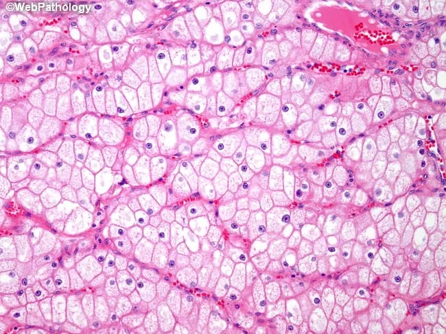 Under brightfield illumination the renal tumor tissue displays an alveolar, organoid pattern consistent with chromophobe renal cell carcinoma. Hematoxylin and eosin stained sections reveal tumor cells with pale pink cytoplasm that is finely reticular rather than optically clear. Cell borders are distinctly thick, giving a plant‑like, boxy outline to each cell, and the cytoplasmic membranes appear prominently delineated. In many fields there are perinuclear halos around nuclei with granular chromatin and relatively small, uniform nuclei, which helps differentiate chromophobe RCC from clear cell RCC, where cytoplasm is typically clear and vacuolated. Vascular networks are elaborate, contributing to the rich intratumoral perfusion seen in this sample. Notably, only a minority of cells exhibit true clear cytoplasm, further arguing against clear cell carcinoma. The combination of reticular cytoplasm, conspicuous cell membranes, and perinuclear halos is characteristic of chromophobe histology, supporting this diagnosis in the appropriate clinical context. From a diagnostic standpoint, these features guide the pathologist toward chromophobe RCC and away from other eosinophilic renal neoplasms such as oncocytoma or papillary RCC. Clinically, recognizing this morphology informs prognosis and potential therapeutic strategies, including surveillance and surgical management. This image exemplifies characteristic chromophobe features and reinforces differential diagnosis in renal neoplasia for education.