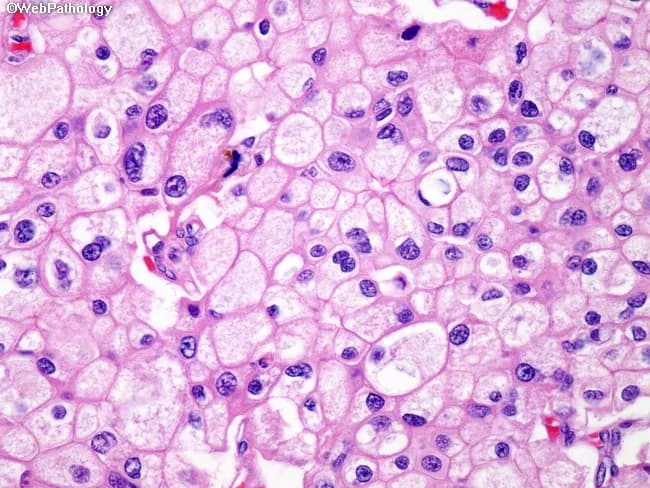 This high-power field represents hematoxylin and eosin stained renal tumor tissue from a chromophobe renal cell carcinoma. The microscope image shows solid/nested growth of polygonal tumor cells with distinct cell borders and ample cytoplasm characterized by a fine reticular eosinophilic pattern. Nuclei are generally central with clumped chromatin; focal binucleation and mild pleomorphism are evident, with small nucleoli. The cytoplasm appears reticular and pale to eosinophilic and is often described as raisinoid in chromophobe RCC, though in this field the reticular cytoplasm is the prominent feature. The cells are arranged in sheets and nests with minimal cytoplasmic clearing and a light, granular background. The combination of well-demarcated cell membranes, perinuclear clearing (if present), and cohesive cell borders are consistent with chromophobe RCC morphology. Clinically, such features aid in distinguishing chromophobe RCC from clear cell RCC and papillary RCC and from oncocytoma, which tends to display more eosinophilic, granular cytoplasm and uniform nuclei. This image is relevant for diagnostic pathology education, differential diagnosis, and for correlating histology with immunohistochemistry (CK7 positive, CD117 positive) and prognosis. Potential clinical applications include histopathologic confirmation after nephrectomy or biopsy and teaching differential diagnostic reasoning in renal tumors.