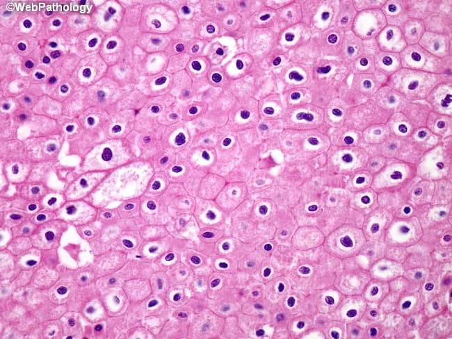 Light microscopy of renal tumor tissue demonstrates chromophobe features with scattered tumor cells showing raisinoid nuclei and prominent nuclear halos. Cells possess very distinct, thick cytoplasmic borders producing a plant-like appearance and pale eosinophilic, reticulated cytoplasm. The architectural pattern is variable, including diffuse and nested arrangements with perinuclear clearing and delicate septae; mitotic activity is usually low. These histologic attributes are characteristic of chromophobe renal cell carcinoma, a renal neoplasm arising from intercalated cells of the collecting ducts. The diagnostic significance lies in the relatively favorable prognosis of chromophobe RCC compared with clear cell RCC when detected early and adequately excised. Immunohistochemical profiling commonly shows CK7 positivity and CD117 positivity, with CAIX negativity, aiding confirmation in challenging cases. Differential considerations include oncocytoma, papillary RCC, and clear cell RCC; correlation with imaging, clinical history, and molecular studies may be necessary. Clinically, the image is relevant for education in renal tumor pathology, histologic differential diagnosis, and pathology-based decision making in urologic oncology. This histology supports surgical planning, staging, and prognostication in patients with renal masses. The visual cues - raisinoid nuclei, nuclear halos, and plant-like cytoplasmic membranes - are critical for recognizing chromophobe RCC in diagnostic practice.